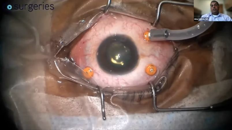 Surgical Repair of a Macular Hole