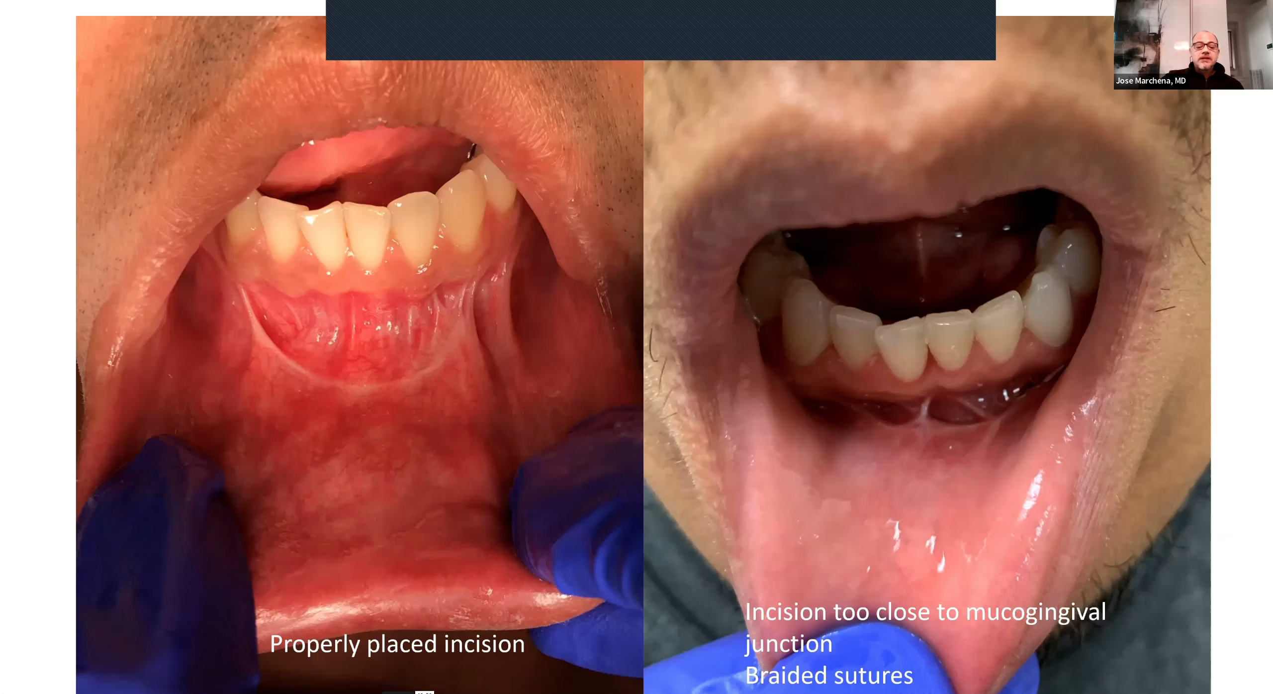 Transoral Approach to Mandibular Fractures: Tips and Tricks