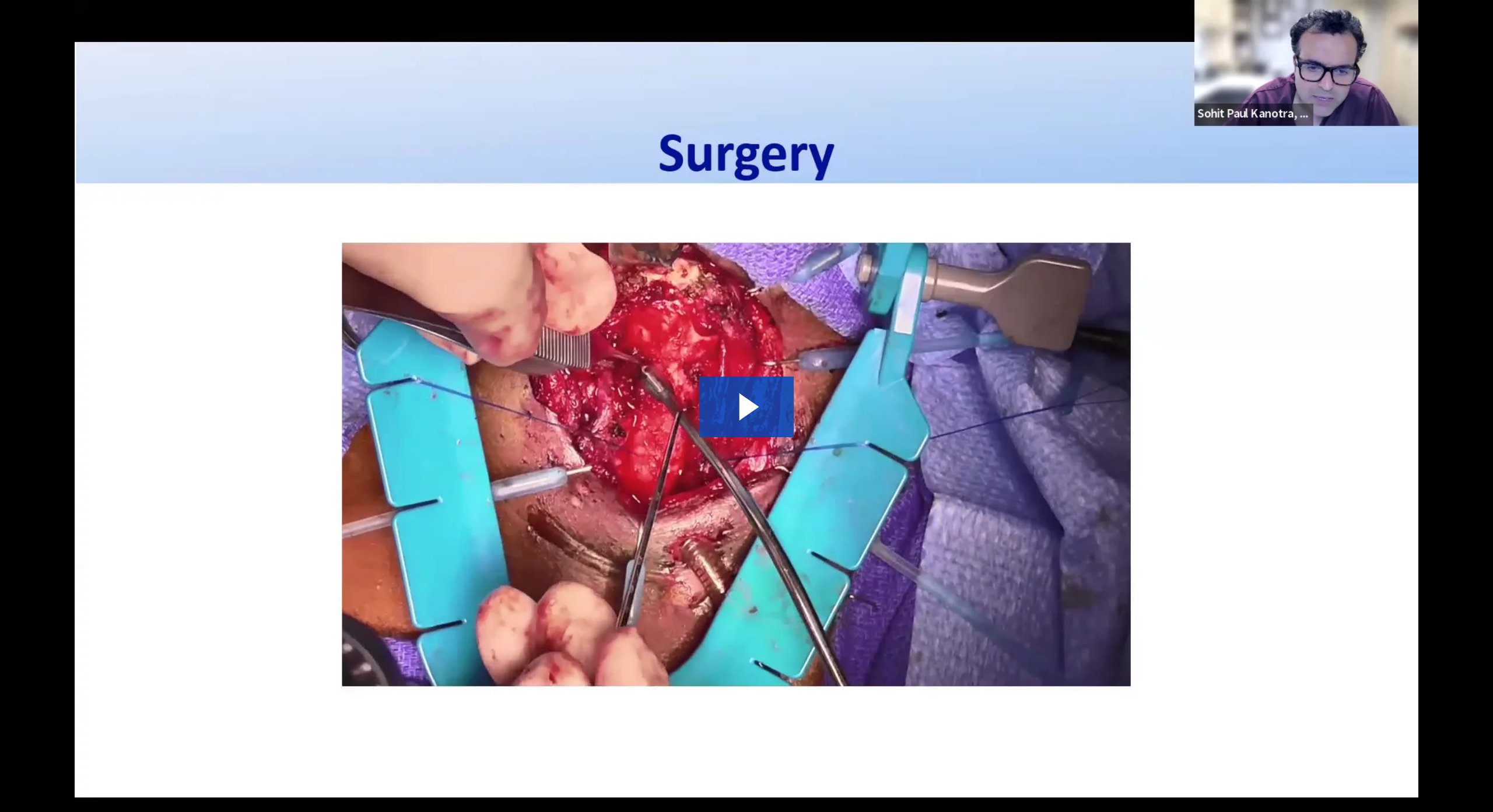 Pediatric Cricotracheal Resection: A Step by Step Surgical Presentation