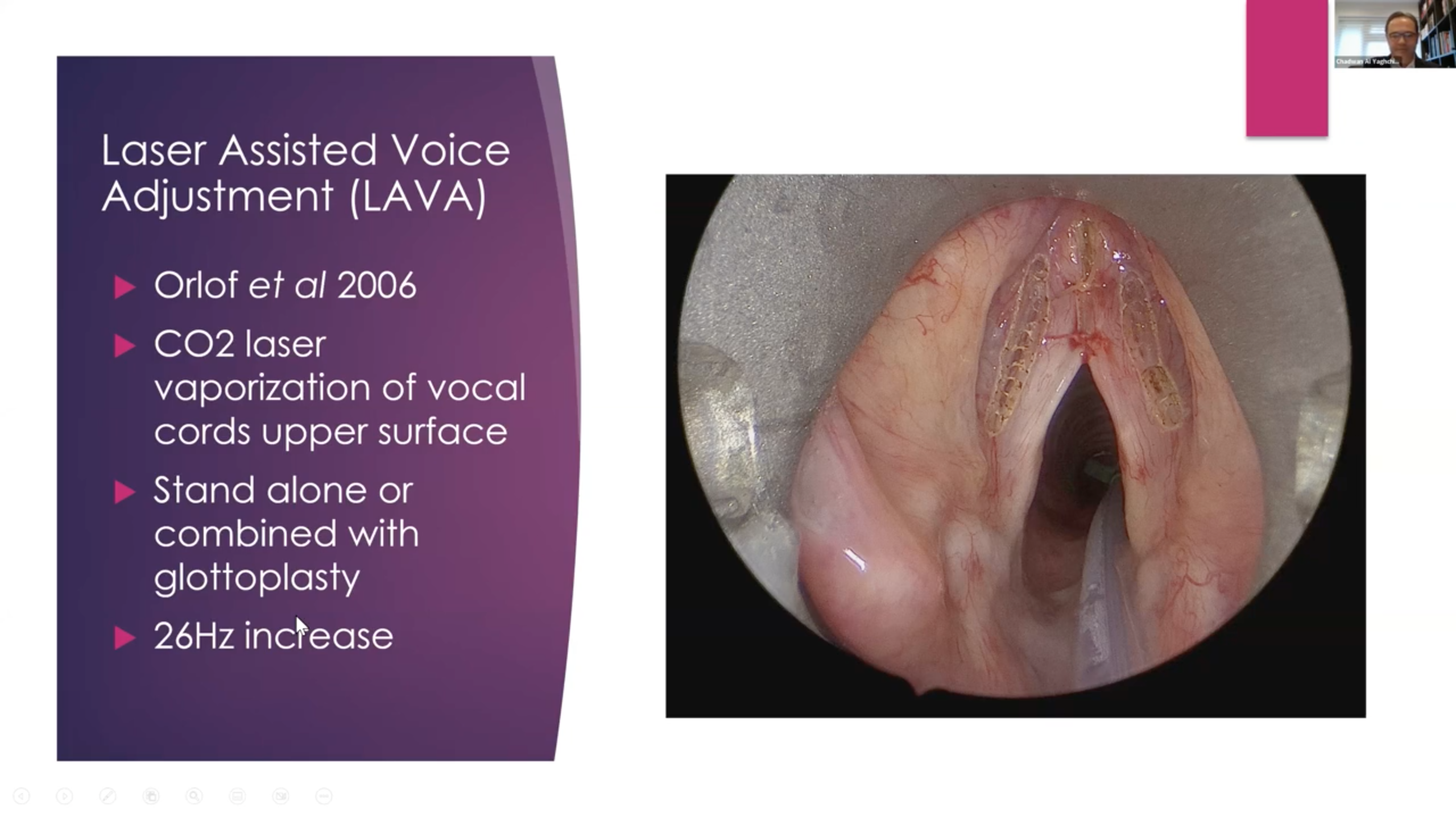 Voice Feminisation Surgery